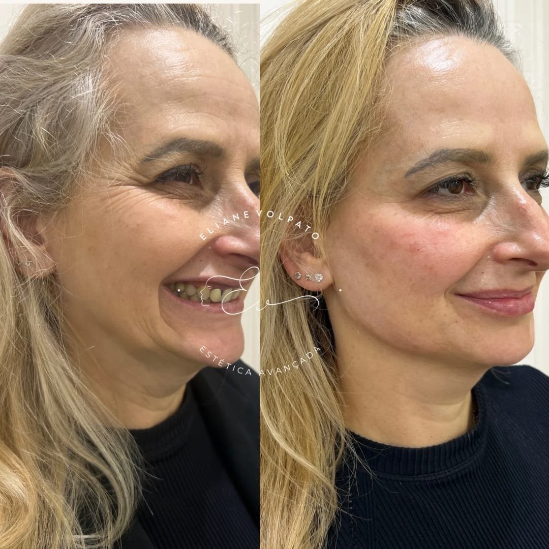 Antes e depois do contorno facial