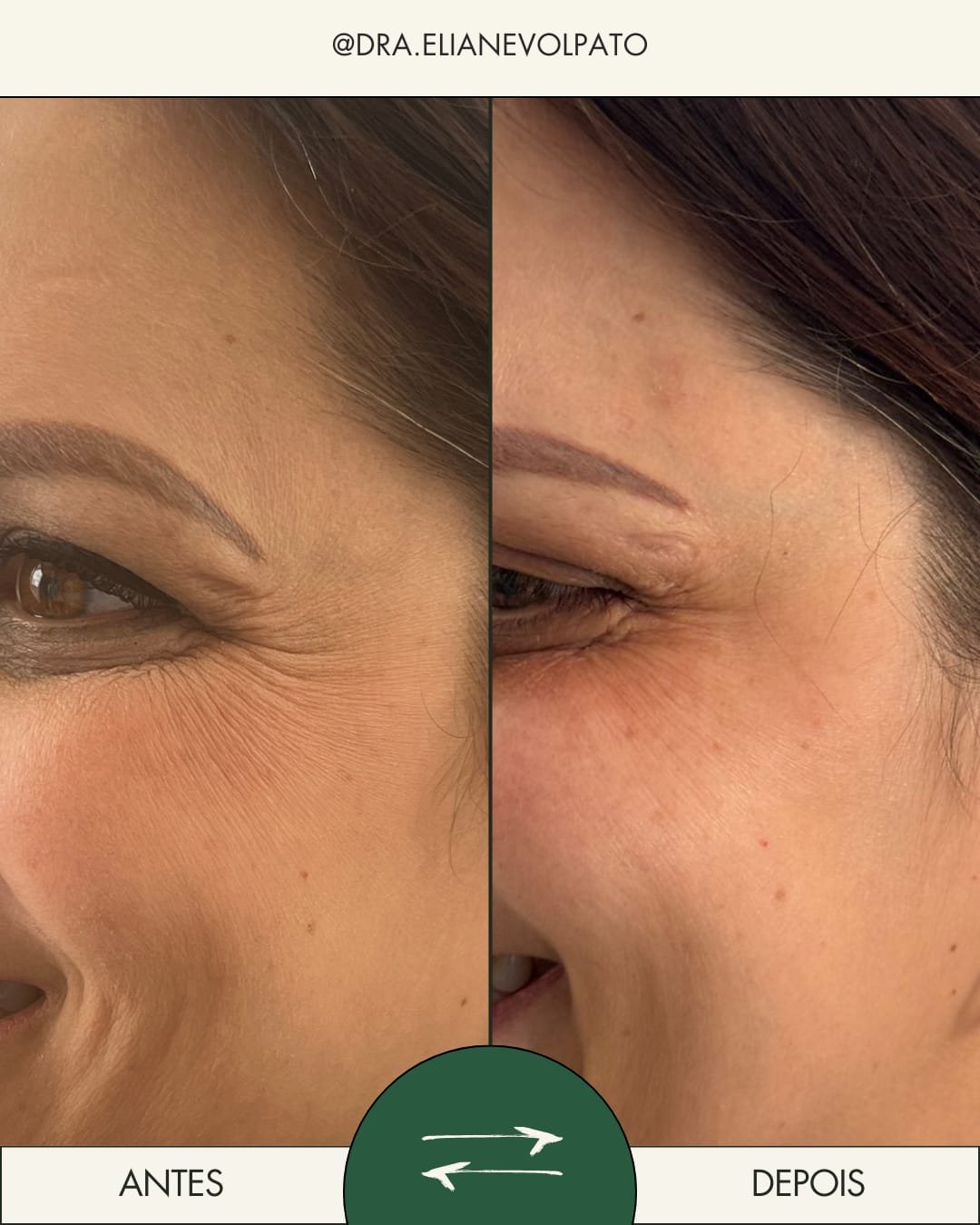 Resultado de tratamento facial com toxina botulínica