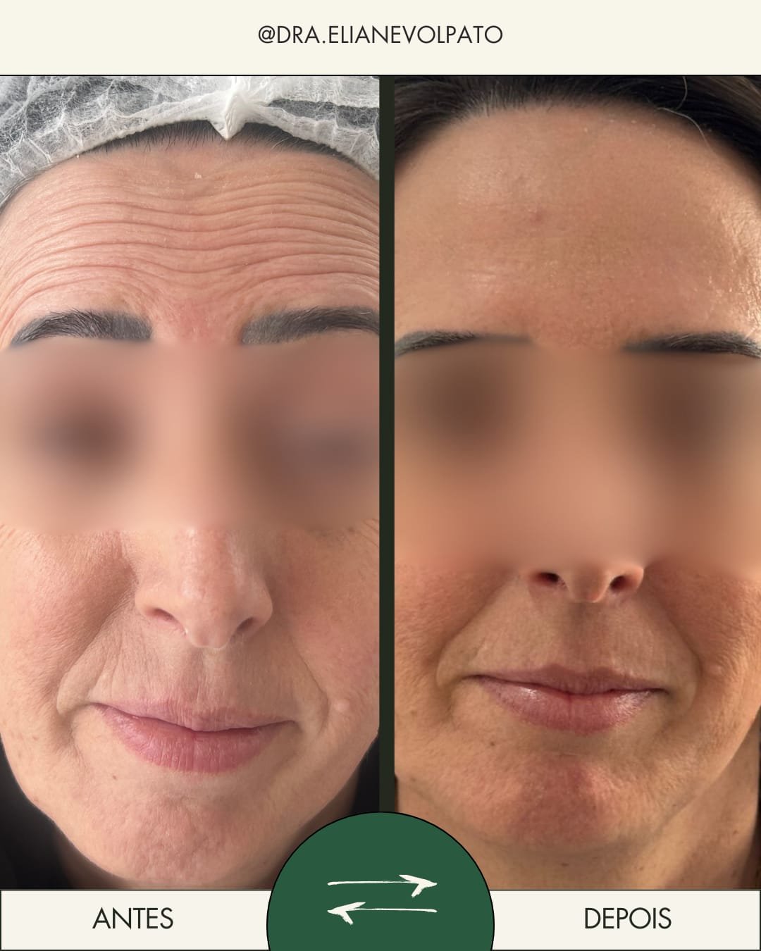 Resultado de protocolo Full Face com toxina botulínica