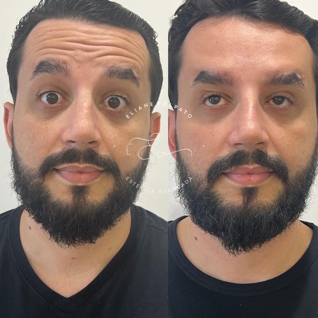 Antes e depois da região da testa e dos olhos